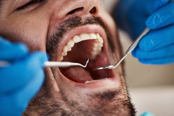 Best Emergency Wisdom Teeth Removal in Seatac, WA