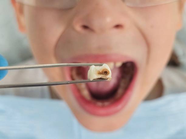 Best Emergency Treatment for Toothache in Seatac, WA